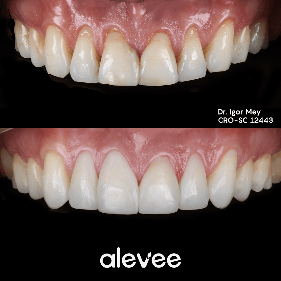 Foto de antes e depois de um tratamento dental.