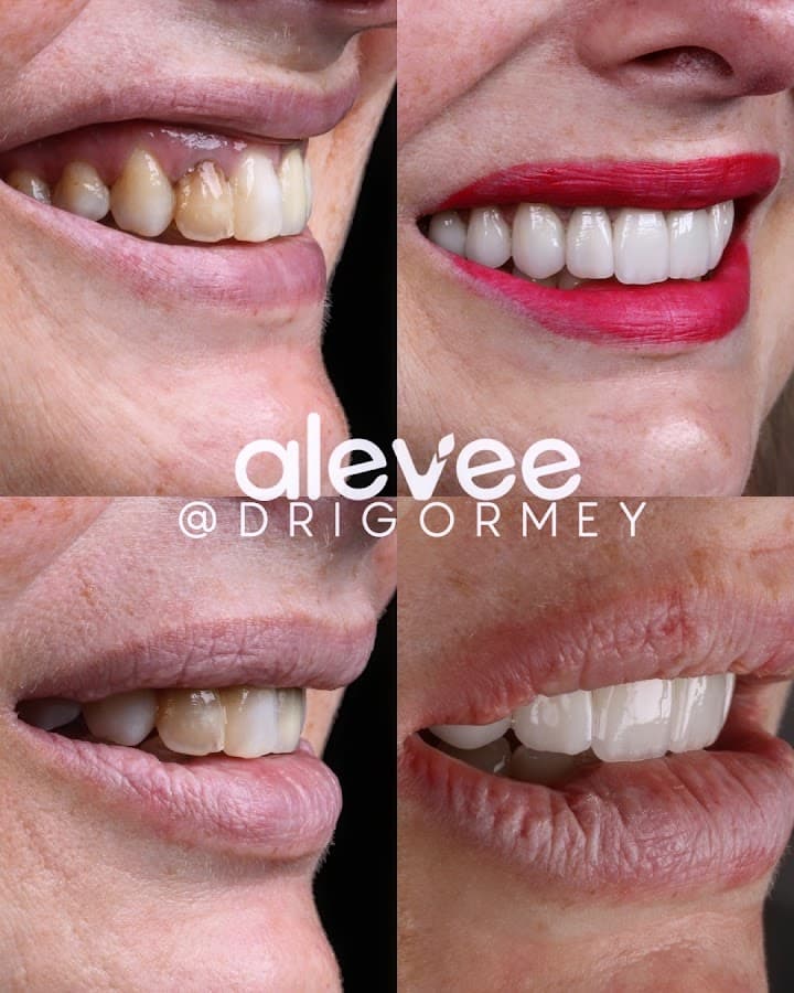 Antes e depois de um tratamento dentário mostrando a melhoria no sorriso.